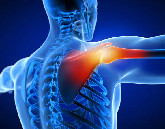 Best-Frozen-Shoulder-Treatments-in-Malaysia